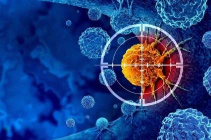 Sensor brasileiro promete detectar câncer de pâncreas em minutos Sensor brasileiro promete detectar câncer de pâncreas em minutos